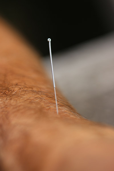 acupuncture - Un point c’est pas tout